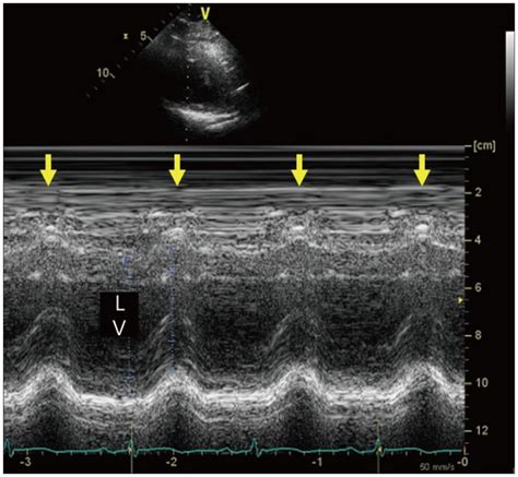 Abnormal Interventricular Septal Motion After Open Heart Surgery