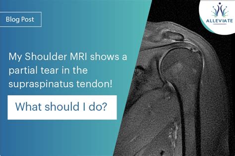 Expert Advice: What to Do When Your Shoulder MRI Reveals a Partial Tear in the Supraspinatus Tendon