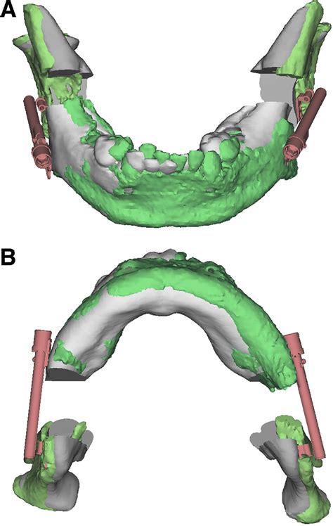 Distraction Osteogenesis As A Treatment For Retrognathia And