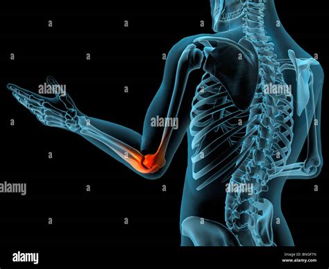 X Ray View Of Elbow Joint With Red Inflammation In A See Through Arm