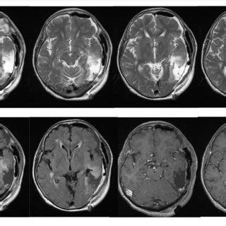 Postoperative MRI Showing Gross Total Removal Of The Tumor