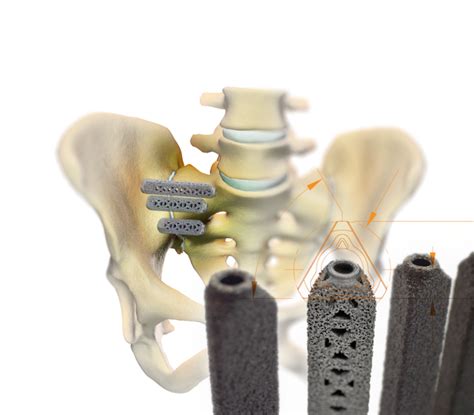 Ifuse Implant System Escondido Ca Southern California Institute Of