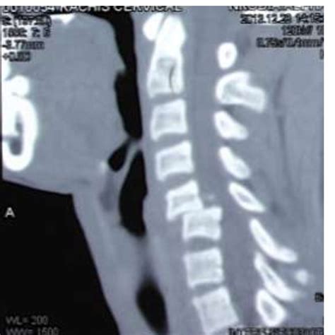 Pdf Prise En Charge Hospitali Re Des Traumatismes Du Rachis Cervical