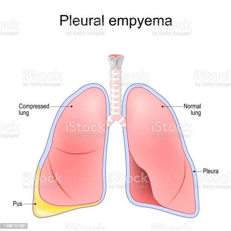 Pleural Empyema Stock Illustration Download Image Now Accidents And