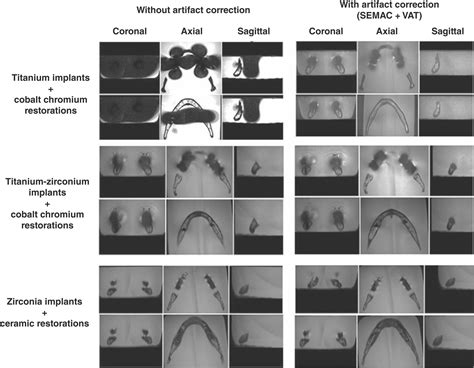 Artifacts In Magnetic Resonance Imaging Of The Head And Neck Unwanted