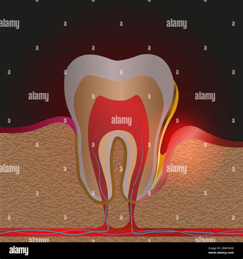 Dental Disease With Pain And Inflammation Medical Illustration Of