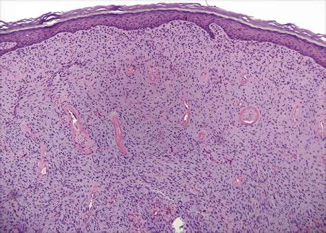 Recurrent Erythematous Vulvar Nodule On A 33 Year Old Woman—quiz Case Jama Dermatology Jama