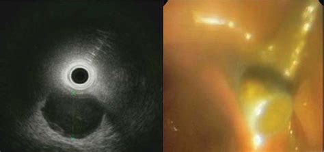 Eus Guided Drainage And Stent Placement For Postoperative Intra