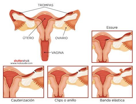 Ligadura De Trompas Qu Es Ventajas Y Consecuencias