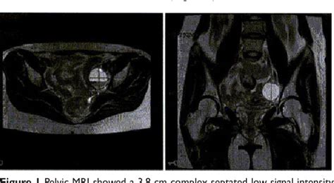 Figure 1 From Da Vinci Sils Appendectomy For Appendiceal Endometriosis