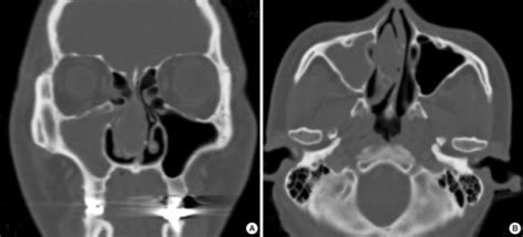 Coronal Axial CT Of The Paranasal Sinus Shows The Open I