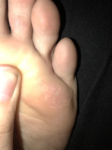 Hard White Bumps On Bottom Of Foot Factory Sale Emergencydentistry