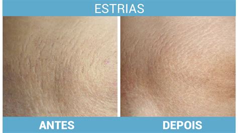 Laser De Co2 Fracionado Dr Szerman Dermatologia Desde 1969 No Rio