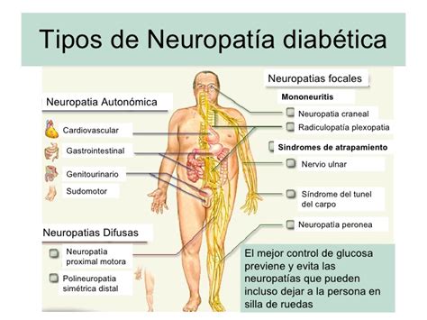 Neuropat A Diab Tica Instituto Nacional Del Diabetico