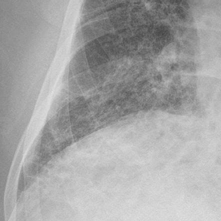 Chronic Kerley B Lines In Congestive Heart Failure Radiology Case