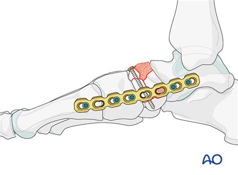 Temporary bridging of talonavicular joint for Complete articular navicular fracture