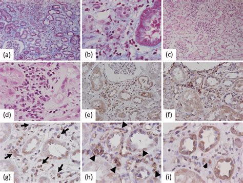 Figure Renal Histology Of Biopsy Specimens A B Marked Mononuclear