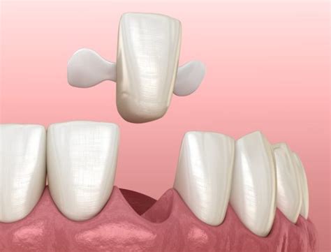 Maryland Dental Bridges A Comprehensive Guide