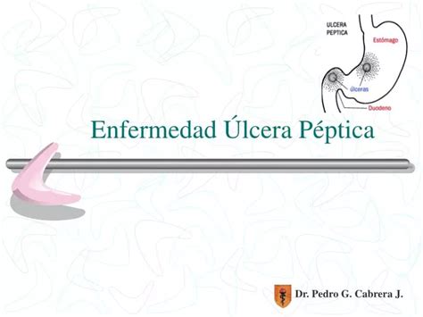 PPT Enfermedad Úlcera Péptica PowerPoint Presentation free download