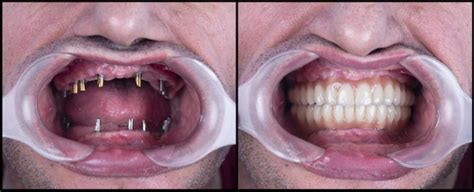 fixed detachable prosthesis largo smiles dental center