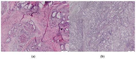 Biomedicines Free Full Text Isolated Gastric Metastases Of