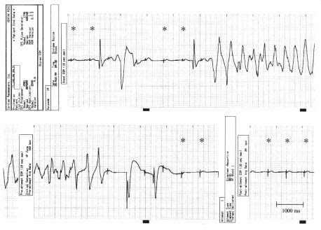 An Intracardiac Electrogram Showing A Nonsustained Episode Of