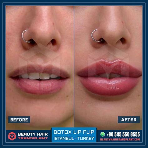 Lip Plumping Results In Istanbul Lip Surgery Botox Lips Botox Before