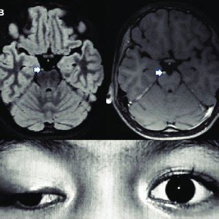 (a) Right eye ptosis with a "down and out" position of the eyeball ...