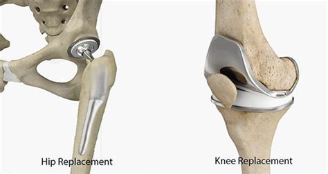 arthroplasty joint replacement align  ortho chennai
