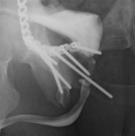 Follow Up Retrograde Urethrogram Of Fluoroscopic Primary Posterior Download Scientific Diagram