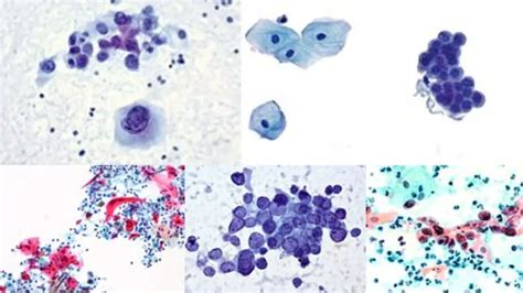 Papanicolaou Staining Pap Stain Principle Procedure Results