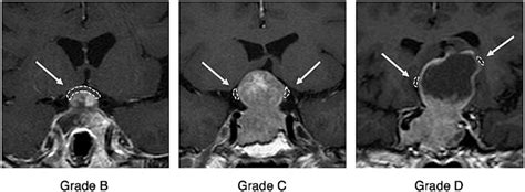 Grade B C And D Pituitary Adenomas With Suprasellar Extension