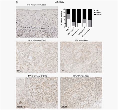 In Situ Hybridization Analysis Of Mirnas In Opscc Formalin Fixed