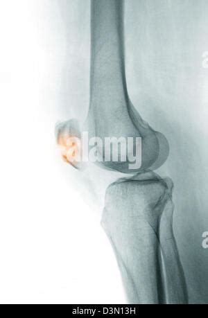 X Ray Zeigt Eine Fraktur Der Patella Kniescheibe Stockfotografie Alamy