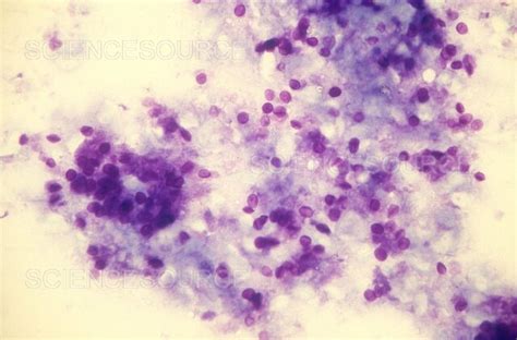 Photograph Pneumocystis Jirovecii Lm Science Source Images