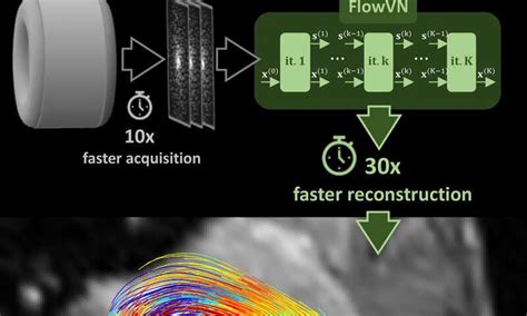 Artificial Intelligence Accelerates Blood Flow Mri