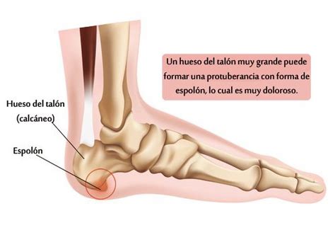 Cu Les Son Los S Ntomas Del Espol N Calc Neo Cl Nica Del Dolor Dr