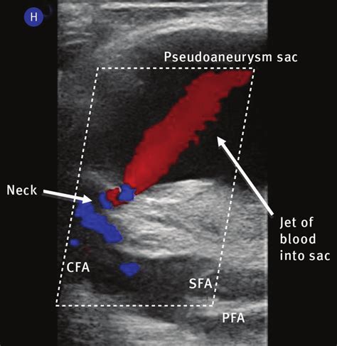 Longitudinal Colour Doppler Ultrasound Image At The Level Of The Right