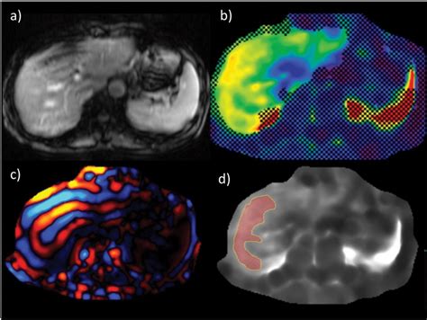 An Example Of Liver Stiffness Measurement By Magnetic Resonance