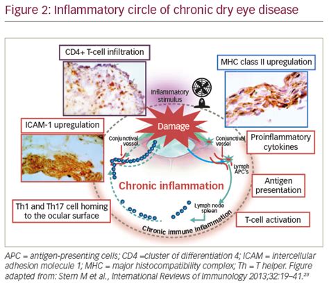 Modern Perspectives On Dry Eye Disease Touchophthalmology