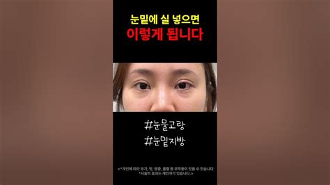 컨실러도 가리지 못하는 눈밑 꺼짐 눈물고랑 눈밑지방 전후비교 눈밑꺼짐 눈밑지방 눈물고랑 다크써클 모즈클리닉