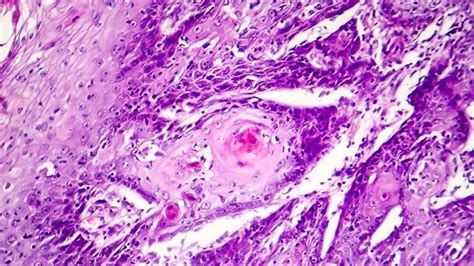 Carcinoma de células escamosas cómo identificar esta forma de cáncer y