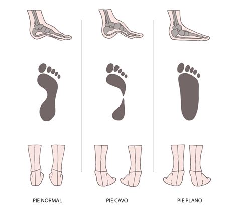 Pie Cavo Y Pie Plano La Configuración Morfológica De La By Ebers Med Medium