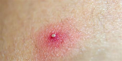 The Possible Treatments To Get Rid Of Pustules Pustules Acne Acne Treatment Pustule Acne