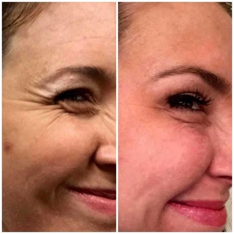 Botox Before And After Crows Feet Photo Facelift Info Prices