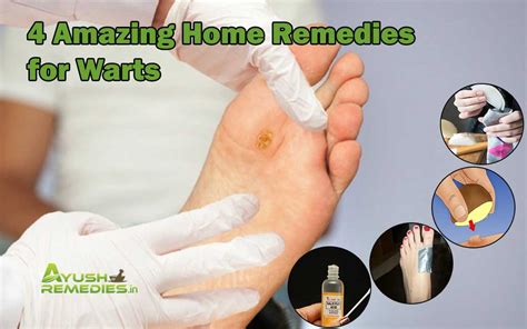 4 Home Remedies for Warts on Face, Head, Hands and Feet