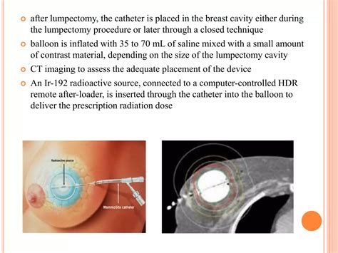 Accelerated Partial Breast Irradiation Ppt