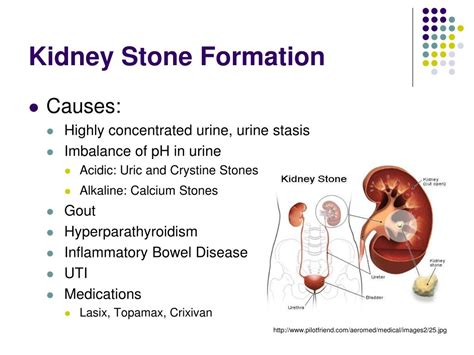kidney stones powerpoint    id