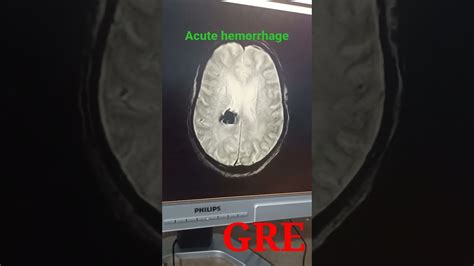 Mri Brain Gre Sequence Axial Acute Hemorrhage Youtube