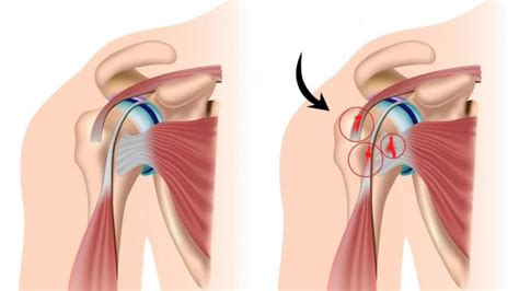 Laparoscopic Surgery Of Rotator Cuff Sutures Vinmec